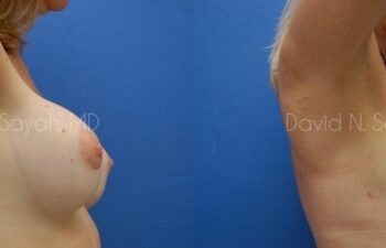 Breast Implant Revision Before and After | Sayah Institute