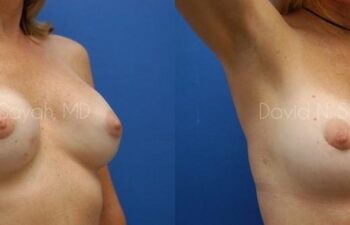 Breast Implant Revision Before and After | Sayah Institute