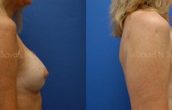 Breast Implant Revision Before and After | Sayah Institute