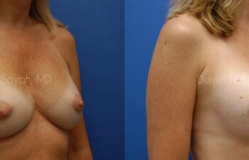 Breast Implant Revision Before and After | Sayah Institute