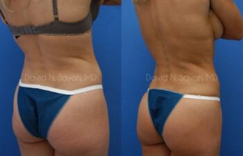 Liposuction Before and After | Sayah Institute