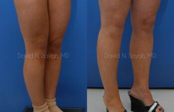 Liposuction Before and After | Sayah Institute