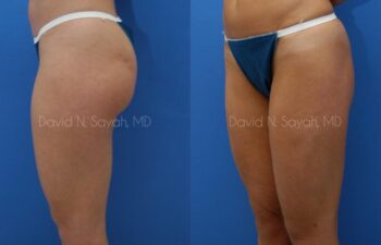 Liposuction Before and After | Sayah Institute