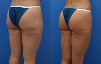 Liposuction Before and After | Sayah Institute