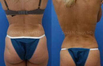 Liposuction Before and After | Sayah Institute