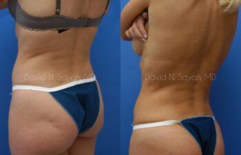 Liposuction Before and After | Sayah Institute
