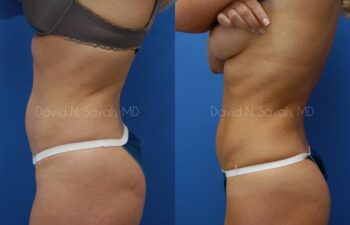 Liposuction Before and After | Sayah Institute