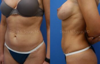 Liposuction Before and After | Sayah Institute