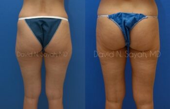 Liposuction Before and After | Sayah Institute