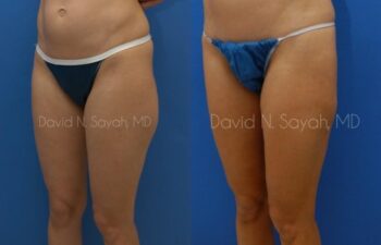 Liposuction Before and After | Sayah Institute