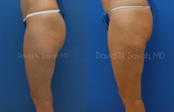 Liposuction Before and After | Sayah Institute