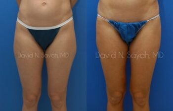 Liposuction Before and After | Sayah Institute
