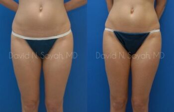 Liposuction Before and After | Sayah Institute