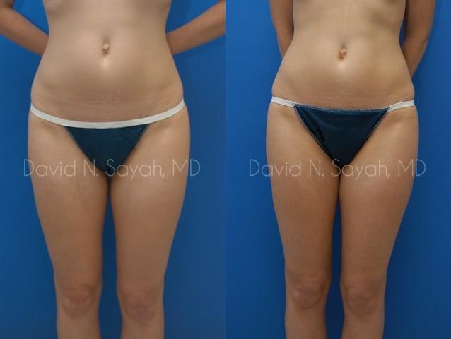 Liposuction Before and After | Sayah Institute