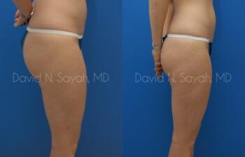 Liposuction Before and After | Sayah Institute