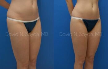 Liposuction Before and After | Sayah Institute