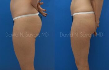 Liposuction Before and After | Sayah Institute