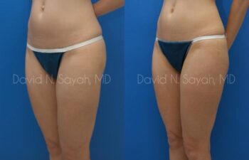 Liposuction Before and After | Sayah Institute
