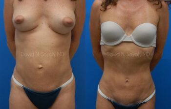 Tummy Tuck Before and After | Sayah Institute