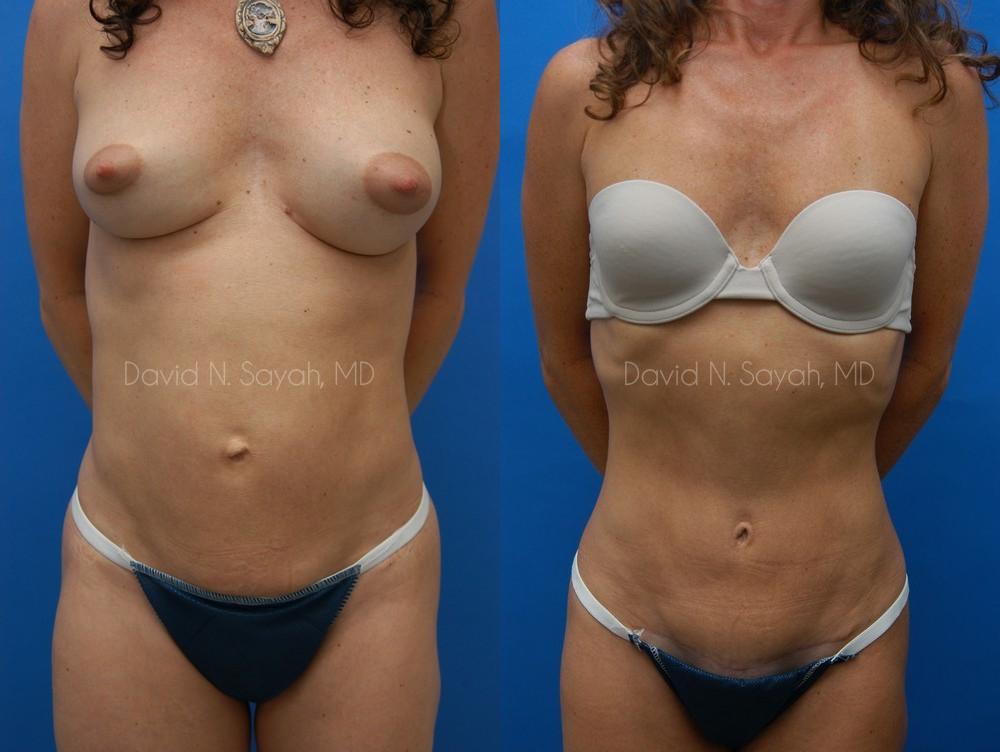 Tummy Tuck Before and After | Sayah Institute