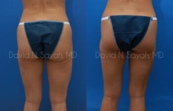 Tummy Tuck Before and After | Sayah Institute