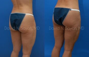 Tummy Tuck Before and After | Sayah Institute