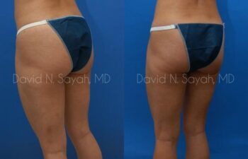 Tummy Tuck Before and After | Sayah Institute
