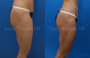 Tummy Tuck Before and After | Sayah Institute