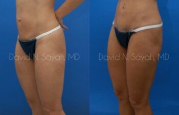 Tummy Tuck Before and After | Sayah Institute