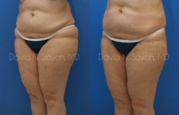 Liposuction Before and After | Sayah Institute