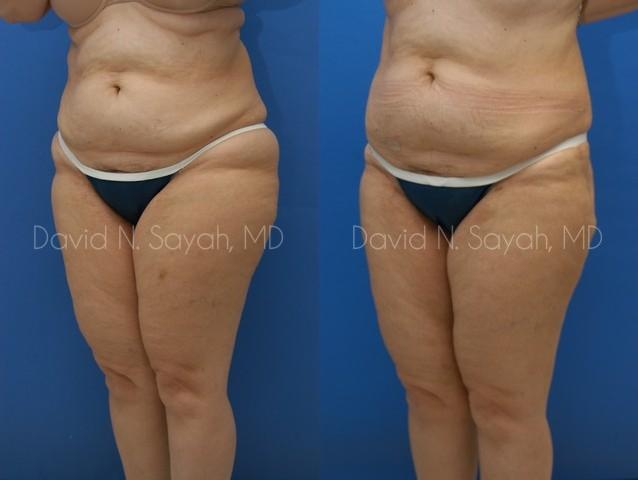 Liposuction Before and After | Sayah Institute