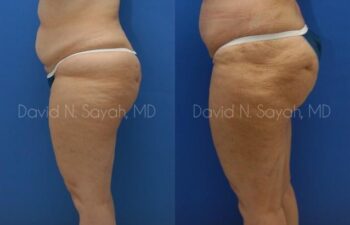 Liposuction Before and After | Sayah Institute