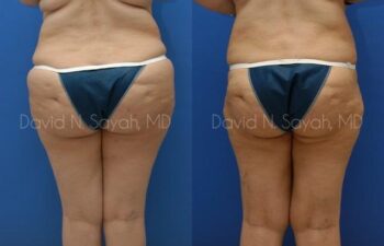 Liposuction Before and After | Sayah Institute