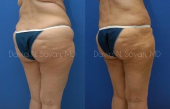 Liposuction Before and After | Sayah Institute