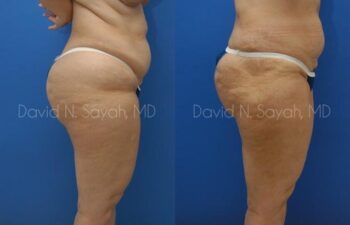 Liposuction Before and After | Sayah Institute