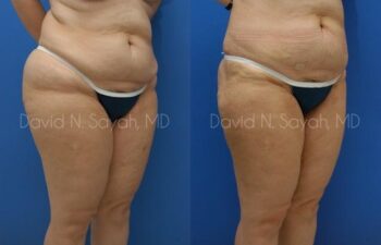 Liposuction Before and After | Sayah Institute