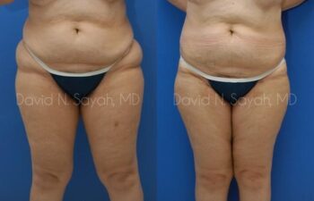 Liposuction Before and After | Sayah Institute