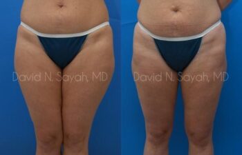 Liposuction Before and After | Sayah Institute