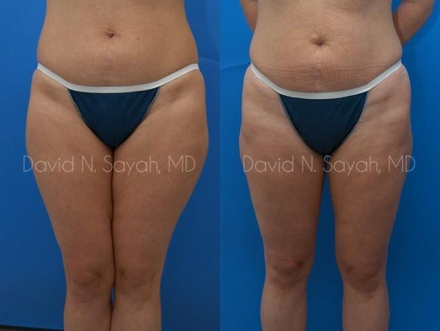 Liposuction Before and After | Sayah Institute