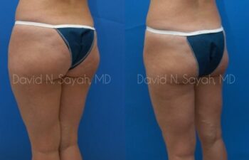 Liposuction Before and After | Sayah Institute