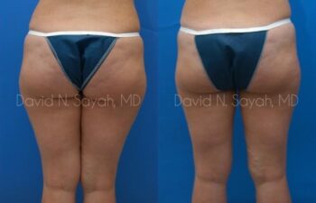 Liposuction Before and After | Sayah Institute