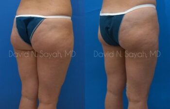 Liposuction Before and After | Sayah Institute