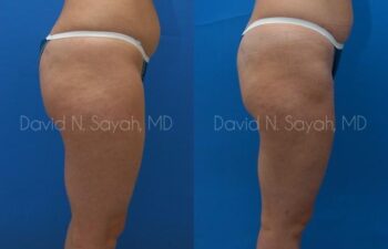 Liposuction Before and After | Sayah Institute