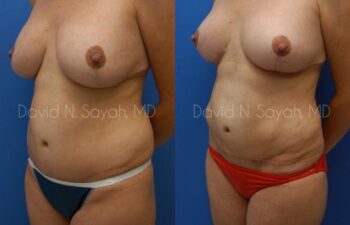 Liposuction Before and After | Sayah Institute