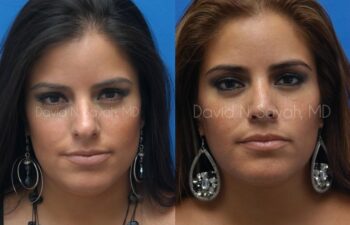 Rhinoplasty Before and After | Sayah Institute