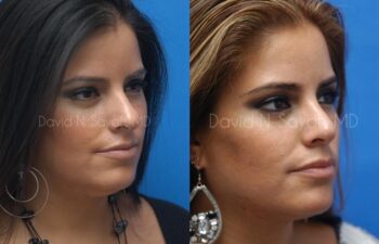 Rhinoplasty Before and After | Sayah Institute