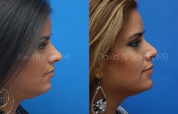 Rhinoplasty Before and After | Sayah Institute