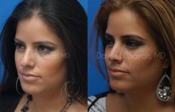 Rhinoplasty Before and After | Sayah Institute