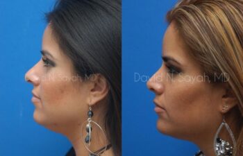Rhinoplasty Before and After | Sayah Institute