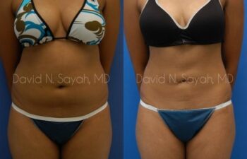 Liposuction Before and After | Sayah Institute
